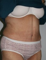 Tummy Tuck