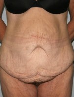 Tummy Tuck