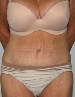 Tummy Tuck