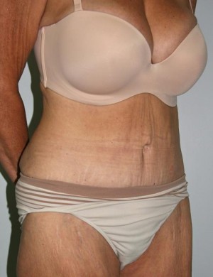 Tummy Tuck