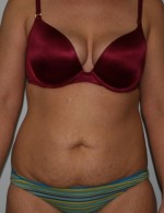 Tummy Tuck