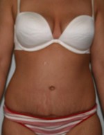 Tummy Tuck