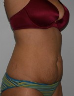 Tummy Tuck
