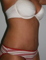 Tummy Tuck