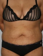 Tummy Tuck