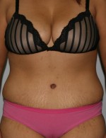Tummy Tuck