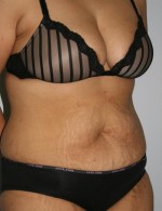 Tummy Tuck
