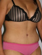 Tummy Tuck