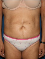 Tummy Tuck