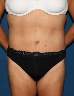 Tummy Tuck