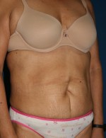 Tummy Tuck