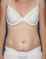 Tummy Tuck
