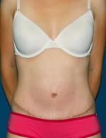 Tummy Tuck