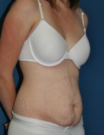 Tummy Tuck