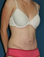 Tummy Tuck