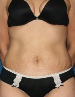 Tummy Tuck