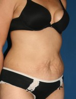 Tummy Tuck