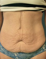 Tummy Tuck