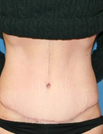 Tummy Tuck