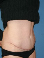 Tummy Tuck