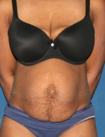 Tummy Tuck