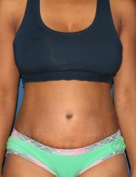 Tummy Tuck
