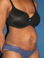 Tummy Tuck