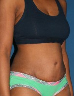 Tummy Tuck