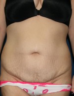 Tummy Tuck