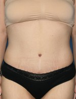 Tummy Tuck