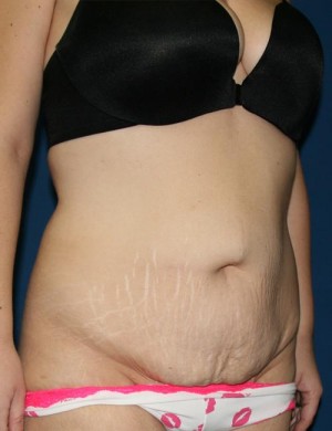 Tummy Tuck