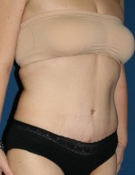 Tummy Tuck
