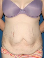 Tummy Tuck
