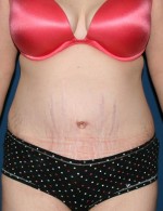 Tummy Tuck