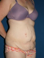 Tummy Tuck