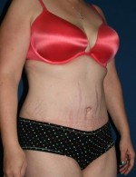 Tummy Tuck