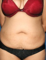 Tummy Tuck