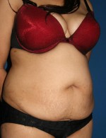 Tummy Tuck