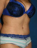Tummy Tuck