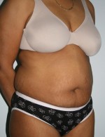Tummy Tuck