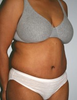 Tummy Tuck