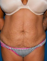 Tummy Tuck