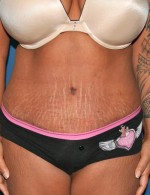 Tummy Tuck
