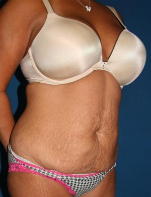 Tummy Tuck