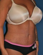 Tummy Tuck