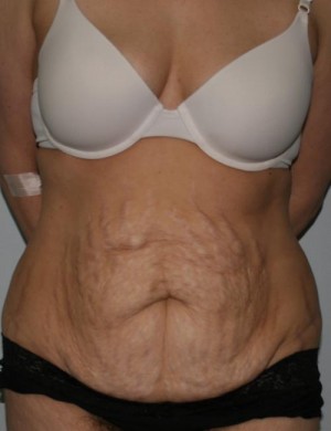 Tummy Tuck