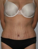 Tummy Tuck