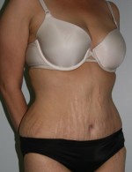 Tummy Tuck