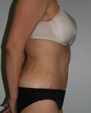 Tummy Tuck