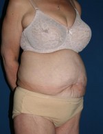 Tummy Tuck